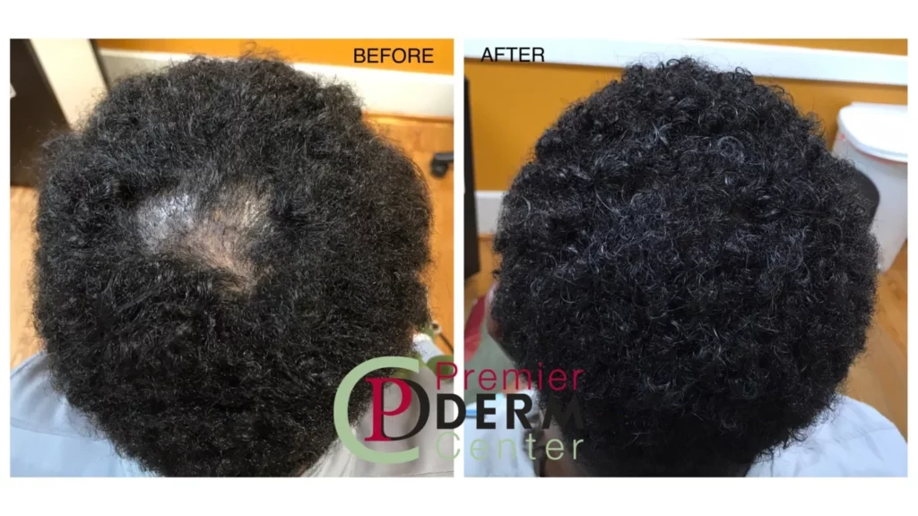hair-restore , Premier Derm Center PLLC | Houston, TX
